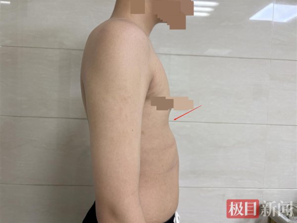 15岁少年患上漏斗胸, 微创手术重塑挺拔胸膛